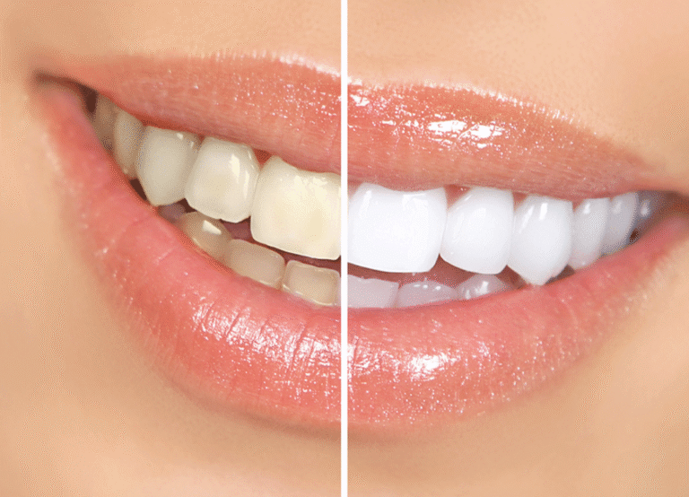 Patient receiving professional teeth whitening in Grayson